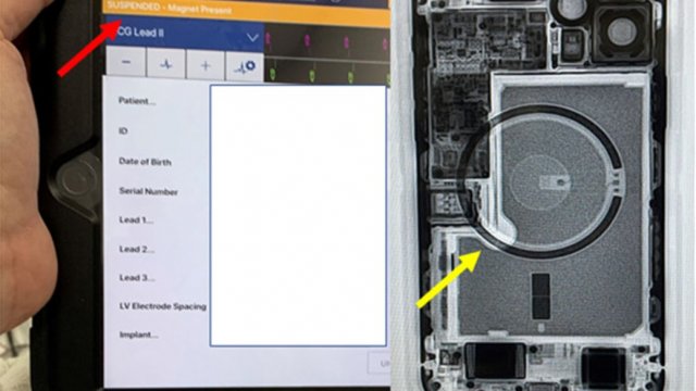 ระวัง!! iPhone 12 รบกวนเครื่องช็อกหัวใจ AICD อาจรุนแรงถึงขั้นเสียชีวิต