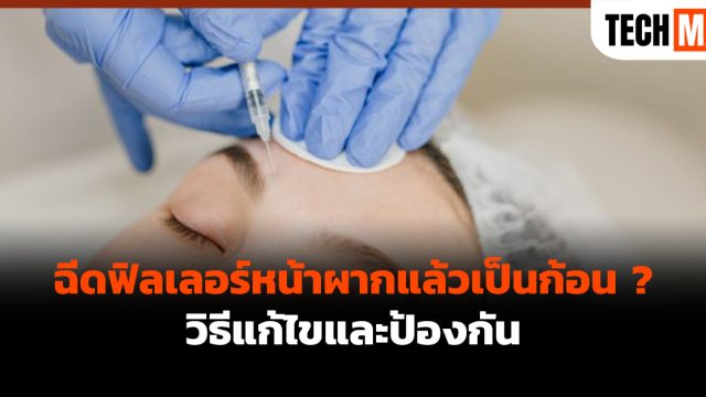 ฉีดฟิลเลอร์หน้าผากแล้วเป็นก้อน ? วิธีแก้ไขและป้องกัน